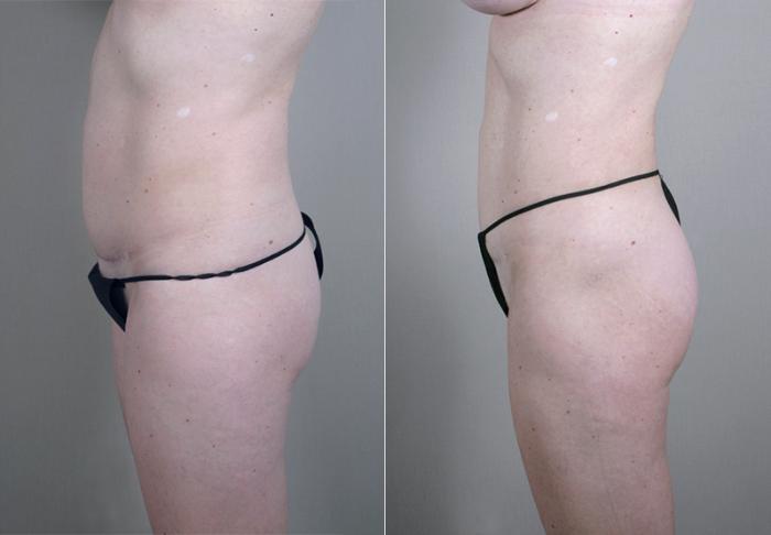 Liposuction Case 384 Before & After View #4 | Paramus, New Jersey | Parker Center for Plastic Surgery