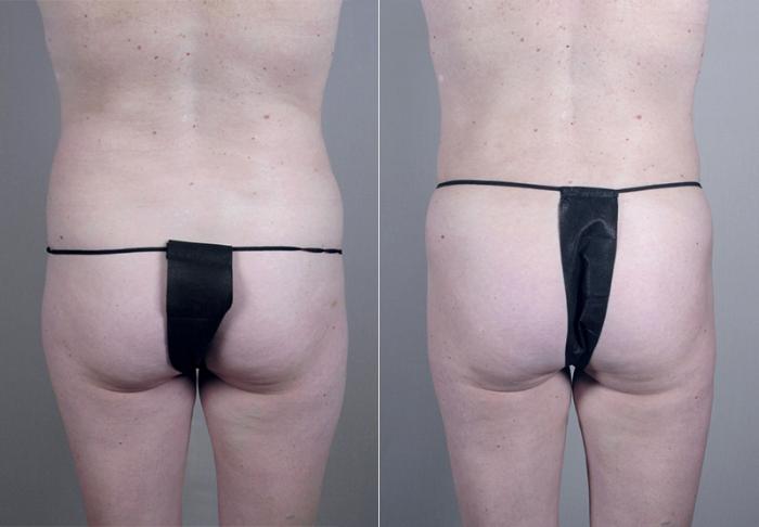Liposuction Case 384 Before & After View #5 | Paramus, New Jersey | Parker Center for Plastic Surgery
