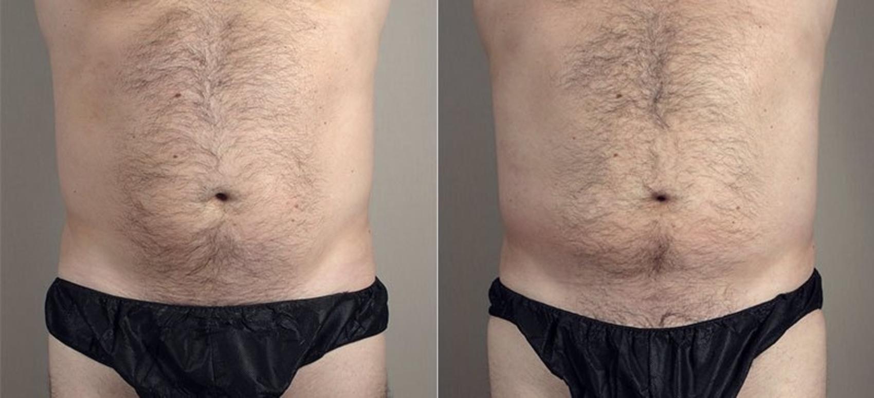 Liposuction Case 669 Before & After View #1 | Paramus, New Jersey | Parker Center for Plastic Surgery