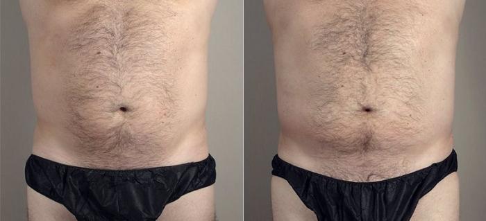 Liposuction Case 669 Before & After View #1 | Paramus, New Jersey | Parker Center for Plastic Surgery