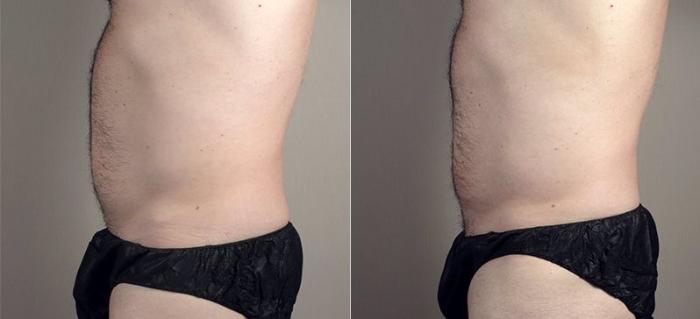 Liposuction Case 669 Before & After View #2 | Paramus, New Jersey | Parker Center for Plastic Surgery