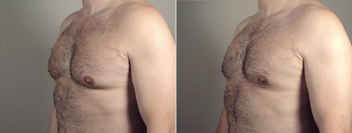 Liposuction Case 669 Before & After View #4 | Paramus, New Jersey | Parker Center for Plastic Surgery