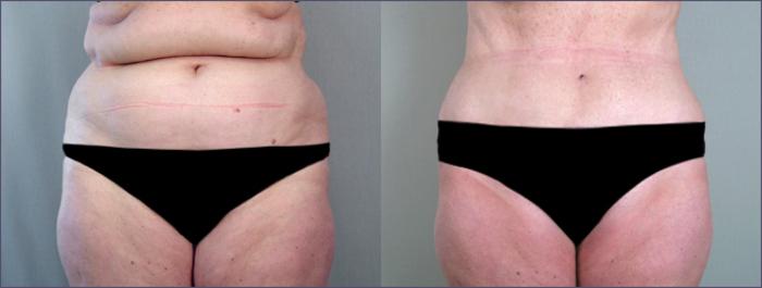 Liposuction Case 685 Before & After View #1 | Paramus, New Jersey | Parker Center for Plastic Surgery