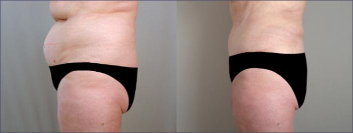 Liposuction Case 685 Before & After View #2 | Paramus, New Jersey | Parker Center for Plastic Surgery