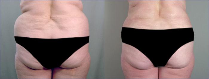 Liposuction Case 685 Before & After View #3 | Paramus, New Jersey | Parker Center for Plastic Surgery