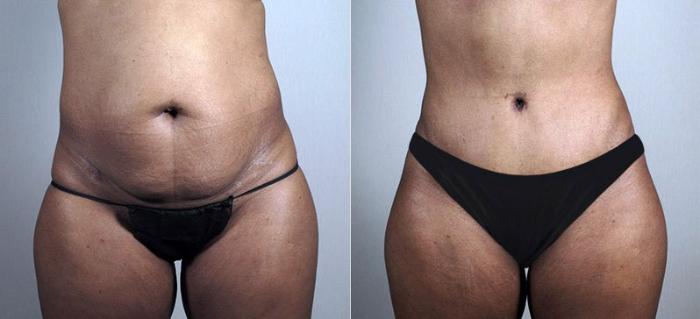 Liposuction Case 730 Before & After View #1 | Paramus, New Jersey | Parker Center for Plastic Surgery