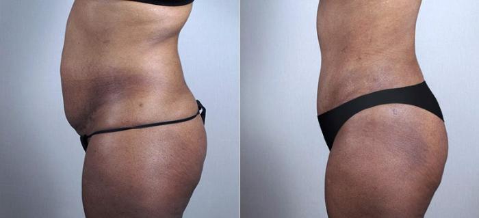 Liposuction Case 730 Before & After View #2 | Paramus, New Jersey | Parker Center for Plastic Surgery