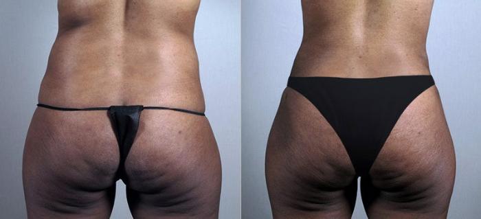 Liposuction Case 730 Before & After View #3 | Paramus, New Jersey | Parker Center for Plastic Surgery