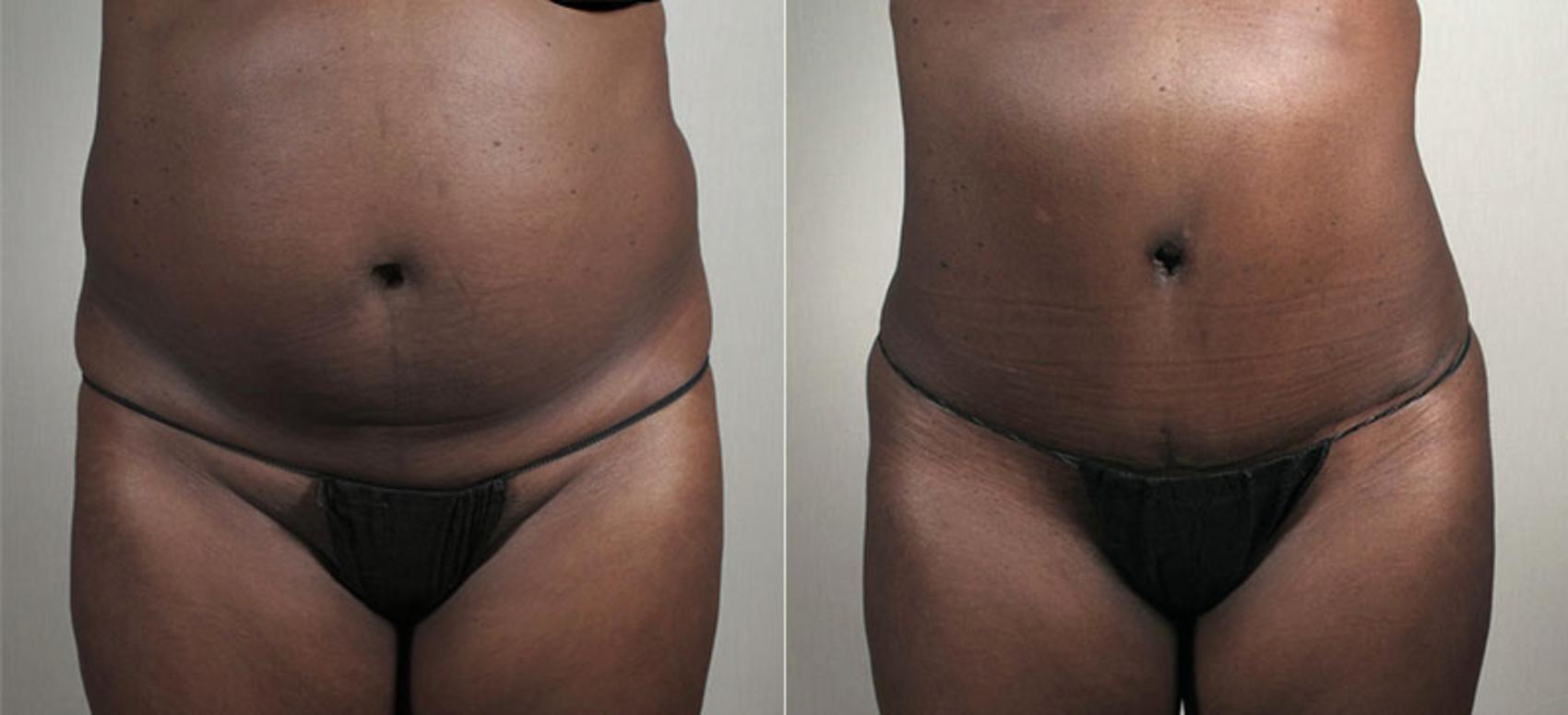 Liposuction Case 735 Before & After View #1 | Paramus, New Jersey | Parker Center for Plastic Surgery