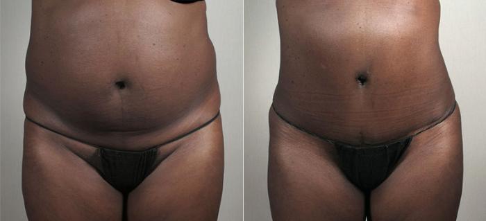 Liposuction Case 735 Before & After View #1 | Paramus, New Jersey | Parker Center for Plastic Surgery