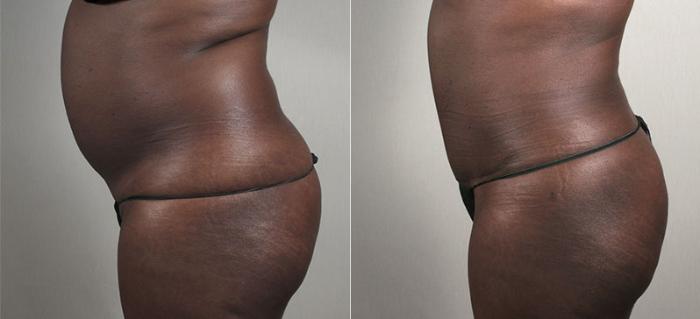 Liposuction Case 735 Before & After View #2 | Paramus, New Jersey | Parker Center for Plastic Surgery