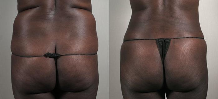 Liposuction Case 735 Before & After View #3 | Paramus, New Jersey | Parker Center for Plastic Surgery