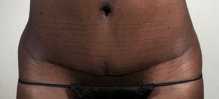 Liposuction Case 735 Before & After View #4 | Paramus, New Jersey | Parker Center for Plastic Surgery