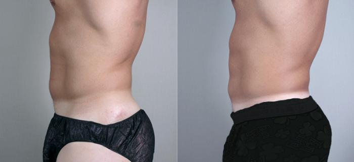 Liposuction Case 758 Before & After View #2 | Paramus, New Jersey | Parker Center for Plastic Surgery