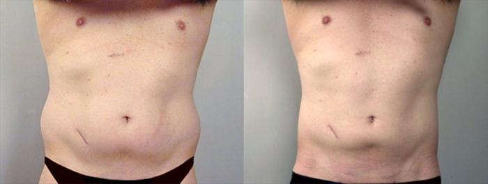 Liposuction Case 759 Before & After View #1 | Paramus, New Jersey | Parker Center for Plastic Surgery