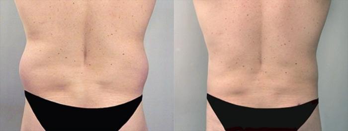Liposuction Case 759 Before & After View #2 | Paramus, New Jersey | Parker Center for Plastic Surgery