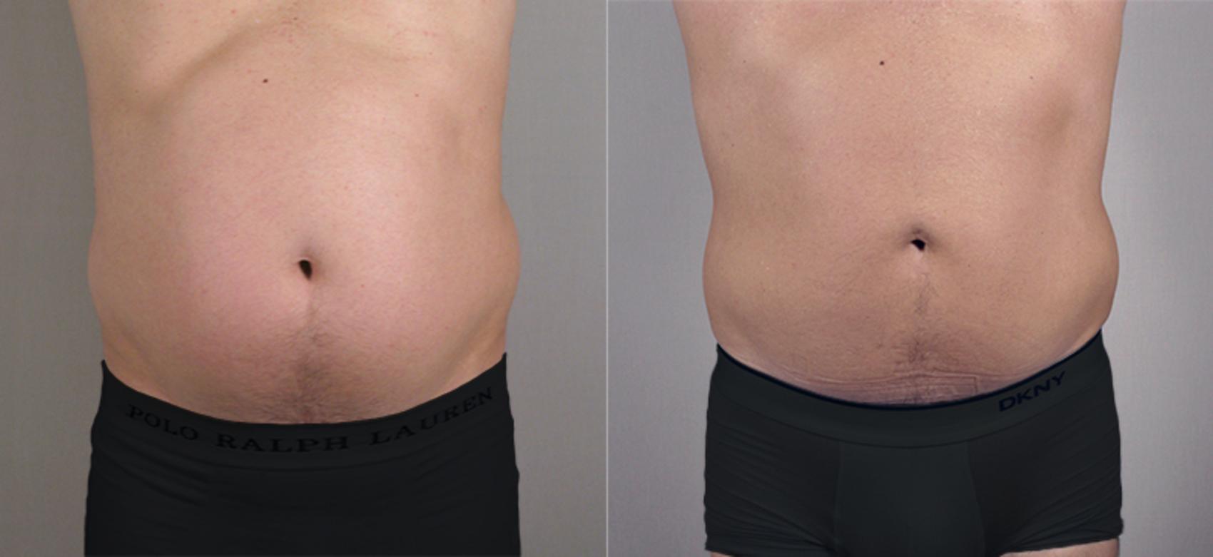 Liposuction Case 760 Before & After View #1 | Paramus, New Jersey | Parker Center for Plastic Surgery