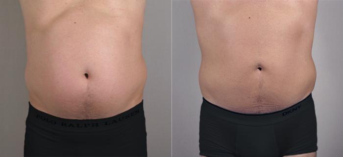 Liposuction Case 760 Before & After View #1 | Paramus, New Jersey | Parker Center for Plastic Surgery