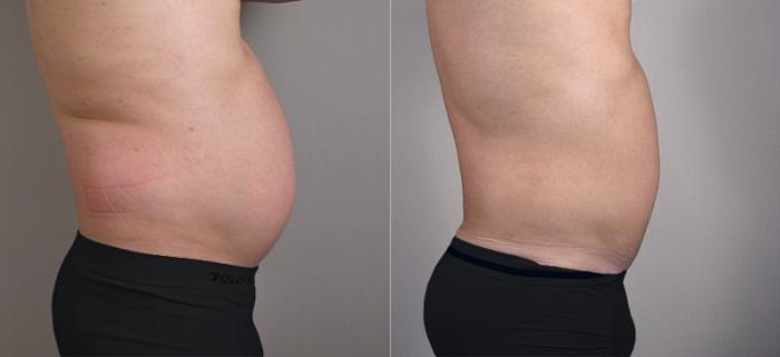 Liposuction Case 760 Before & After View #2 | Paramus, New Jersey | Parker Center for Plastic Surgery