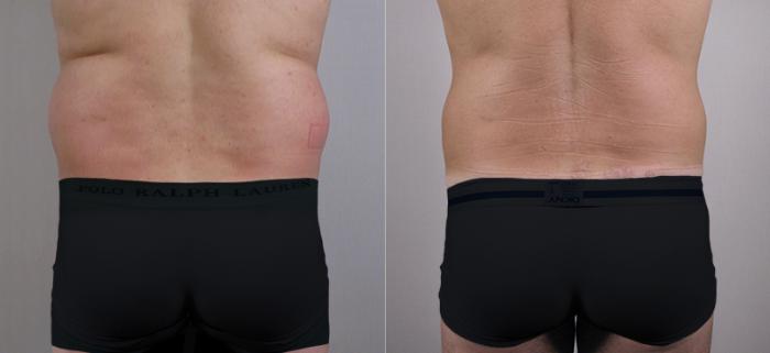 Liposuction Case 760 Before & After View #3 | Paramus, New Jersey | Parker Center for Plastic Surgery