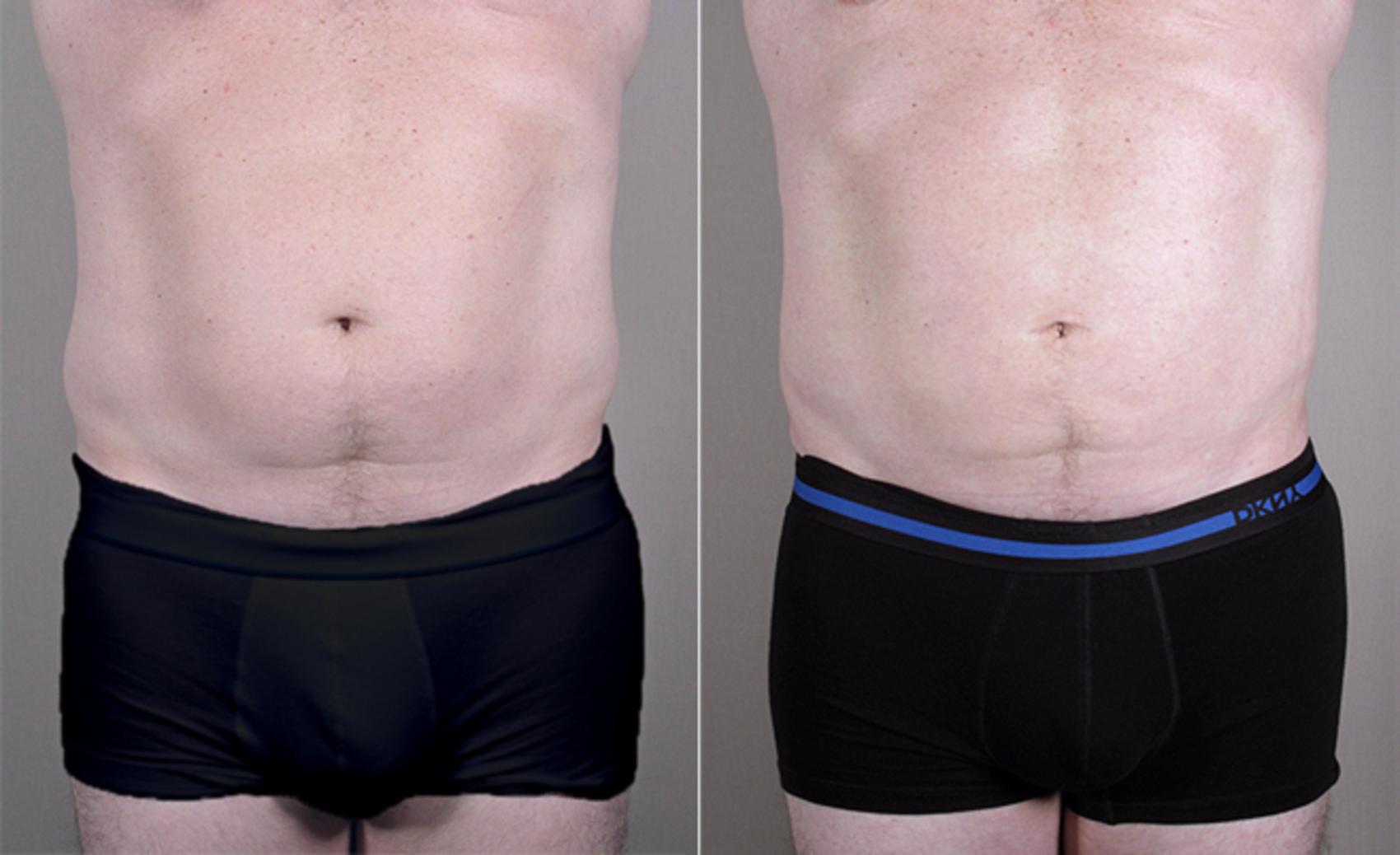 Liposuction Case 761 Before & After View #1 | Paramus, New Jersey | Parker Center for Plastic Surgery