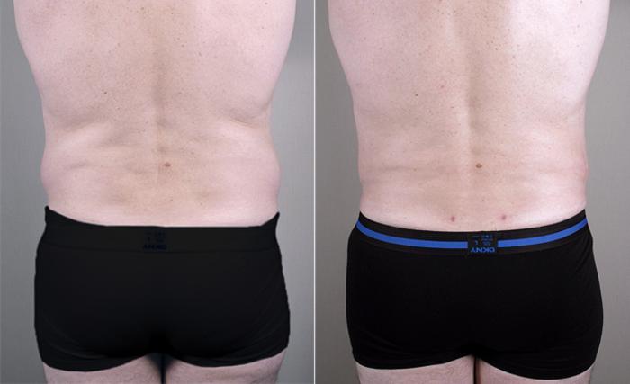 Liposuction Case 761 Before & After View #3 | Paramus, New Jersey | Parker Center for Plastic Surgery