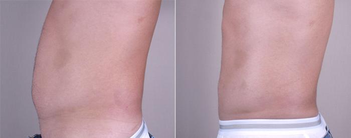 Liposuction Case 762 Before & After View #1 | Paramus, New Jersey | Parker Center for Plastic Surgery
