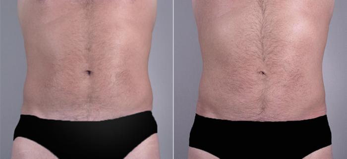 Liposuction Case 763 Before & After View #1 | Paramus, New Jersey | Parker Center for Plastic Surgery