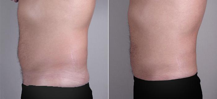 Liposuction Case 763 Before & After View #2 | Paramus, New Jersey | Parker Center for Plastic Surgery