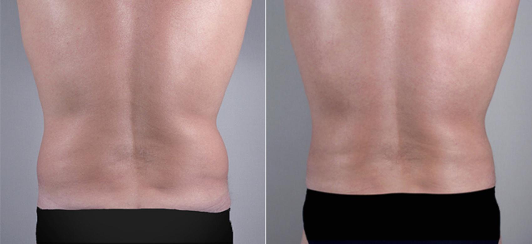 Liposuction Case 763 Before & After View #3 | Paramus, New Jersey | Parker Center for Plastic Surgery