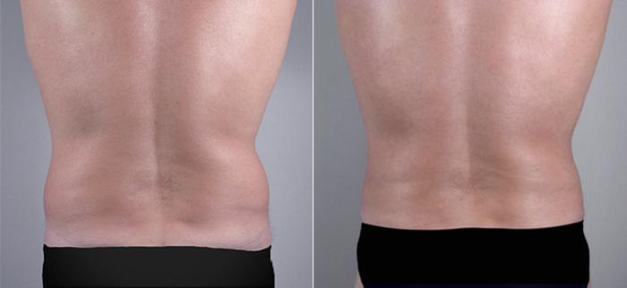 Liposuction Case 763 Before & After View #3 | Paramus, New Jersey | Parker Center for Plastic Surgery