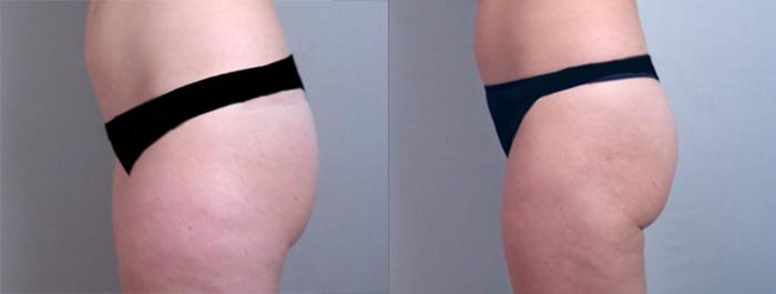Liposuction Case 765 Before & After View #2 | Paramus, New Jersey | Parker Center for Plastic Surgery