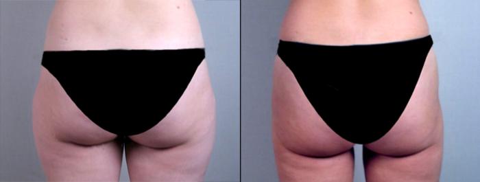Liposuction Case 765 Before & After View #3 | Paramus, New Jersey | Parker Center for Plastic Surgery