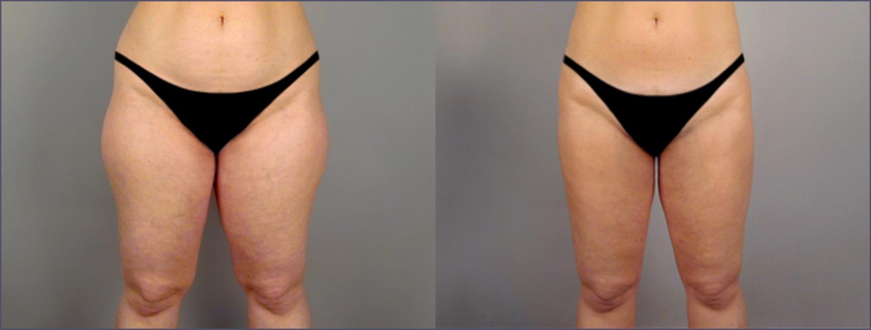 Liposuction Case 766 Before & After View #1 | Paramus, New Jersey | Parker Center for Plastic Surgery