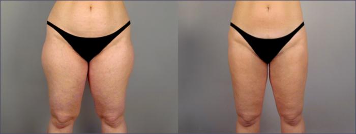 Liposuction Case 766 Before & After View #1 | Paramus, New Jersey | Parker Center for Plastic Surgery