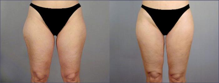 Liposuction Case 767 Before & After View #1 | Paramus, New Jersey | Parker Center for Plastic Surgery