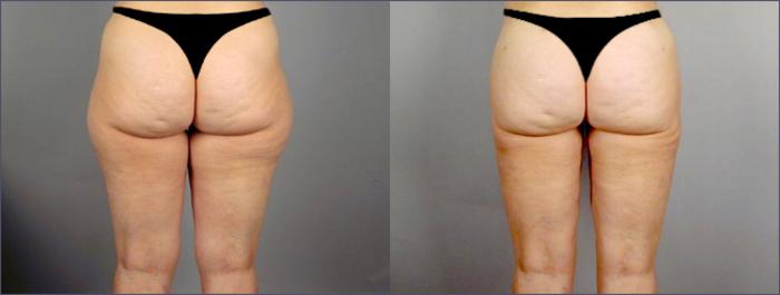 Liposuction Case 767 Before & After View #2 | Paramus, New Jersey | Parker Center for Plastic Surgery