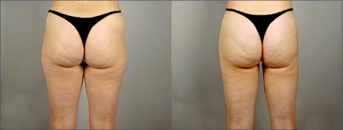 Liposuction Case 768 Before & After View #2 | Paramus, New Jersey | Parker Center for Plastic Surgery