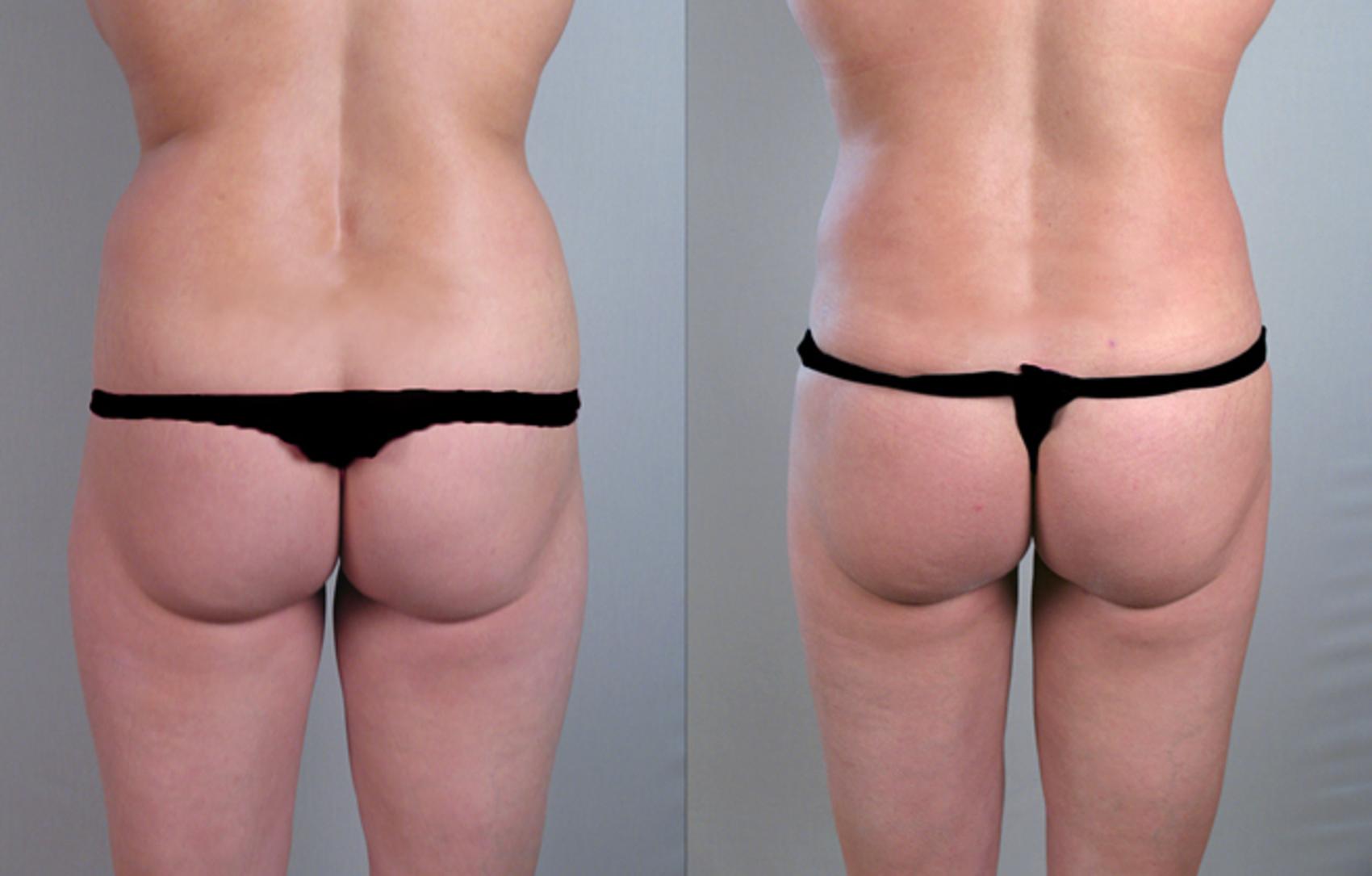 Liposuction Case 771 Before & After View #1 | Paramus, New Jersey | Parker Center for Plastic Surgery
