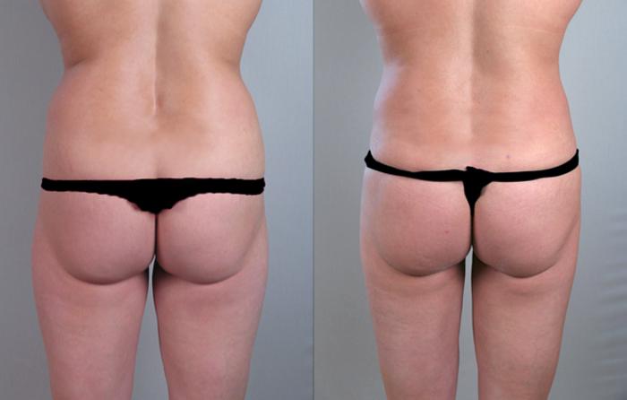 Liposuction Case 771 Before & After View #1 | Paramus, New Jersey | Parker Center for Plastic Surgery