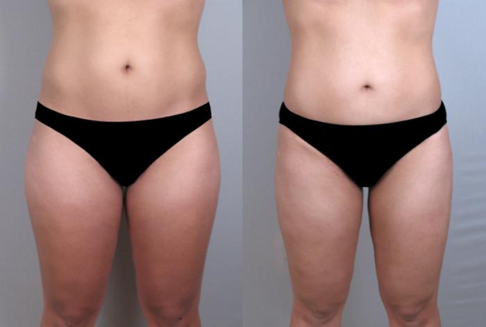 Liposuction Case 772 Before & After View #1 | Paramus, New Jersey | Parker Center for Plastic Surgery