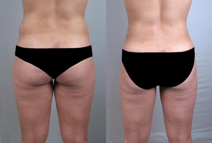 Liposuction Case 772 Before & After View #2 | Paramus, New Jersey | Parker Center for Plastic Surgery