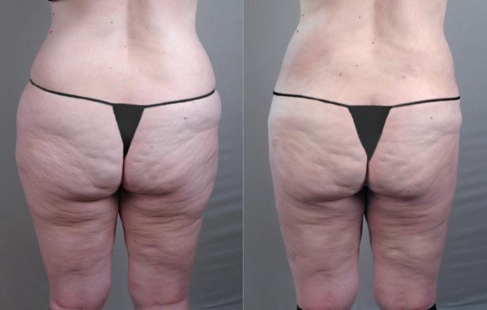 Liposuction Case 773 Before & After View #2 | Paramus, New Jersey | Parker Center for Plastic Surgery