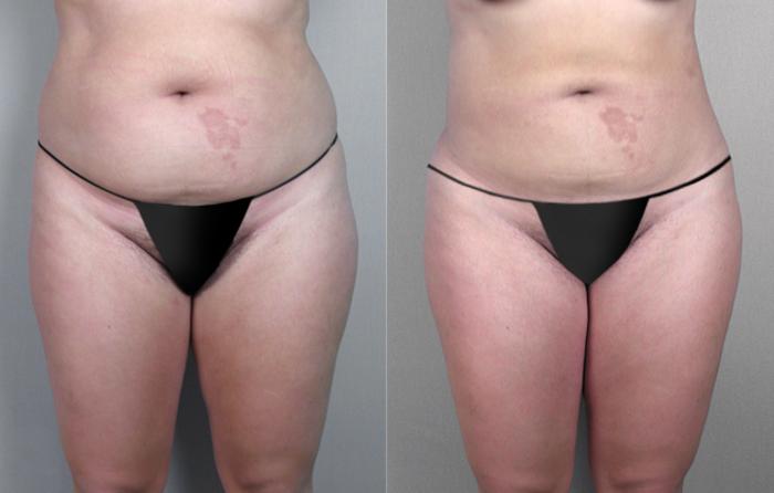 Liposuction Case 774 Before & After View #1 | Paramus, New Jersey | Parker Center for Plastic Surgery