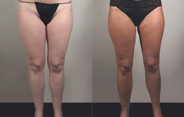 Liposuction Case 777 Before & After View #1 | Paramus, New Jersey | Parker Center for Plastic Surgery