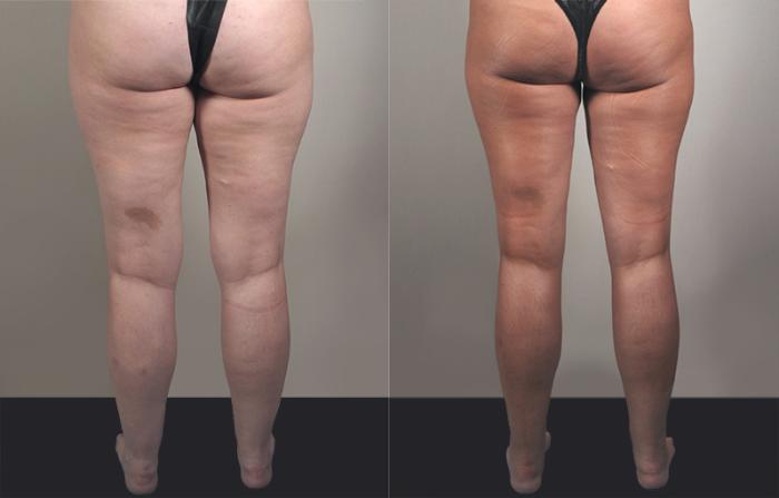 Liposuction Case 777 Before & After View #2 | Paramus, New Jersey | Parker Center for Plastic Surgery