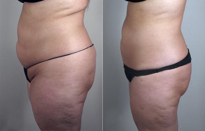Liposuction Case 778 Before & After View #2 | Paramus, New Jersey | Parker Center for Plastic Surgery