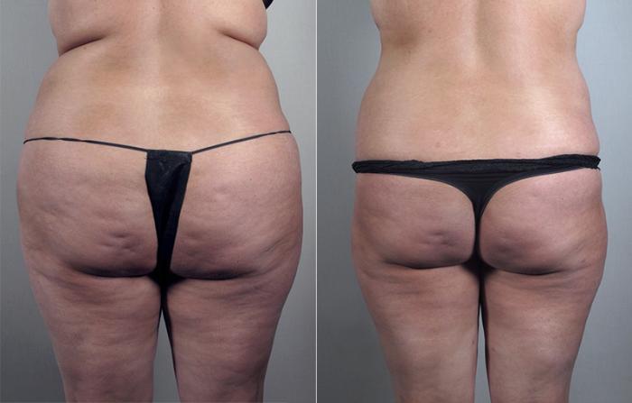 Liposuction Case 778 Before & After View #3 | Paramus, New Jersey | Parker Center for Plastic Surgery