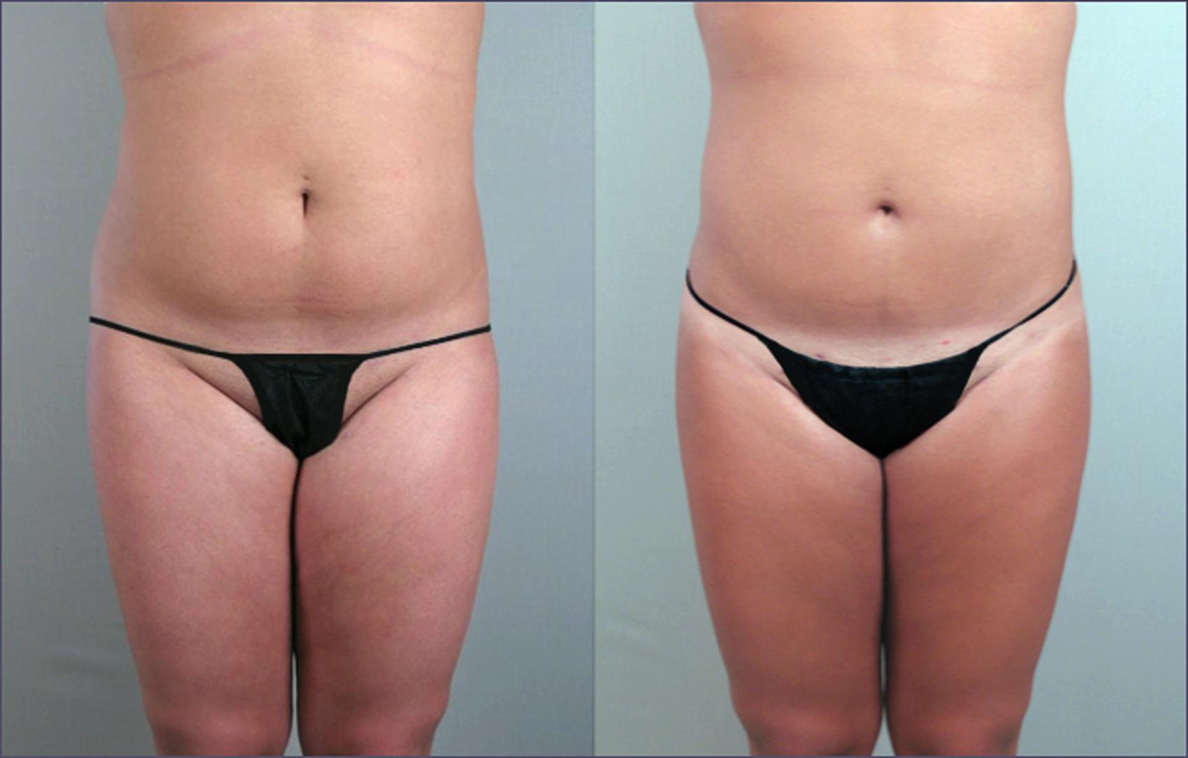 Liposuction Case 779 Before & After View #1 | Paramus, New Jersey | Parker Center for Plastic Surgery