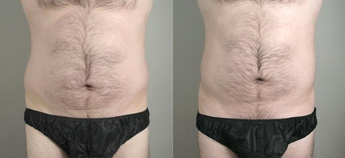 Liposuction Case 780 Before & After View #1 | Paramus, New Jersey | Parker Center for Plastic Surgery